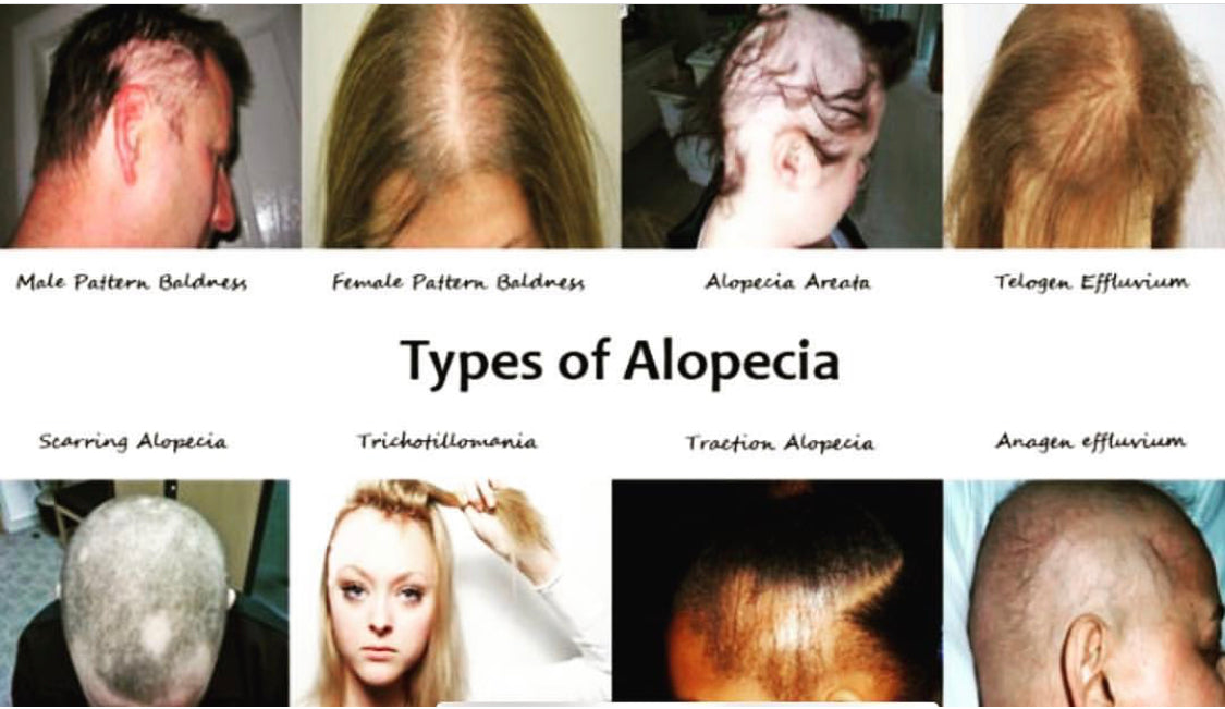 Alopecia Areata - American Osteopathic College of Dermatology (AOCD)